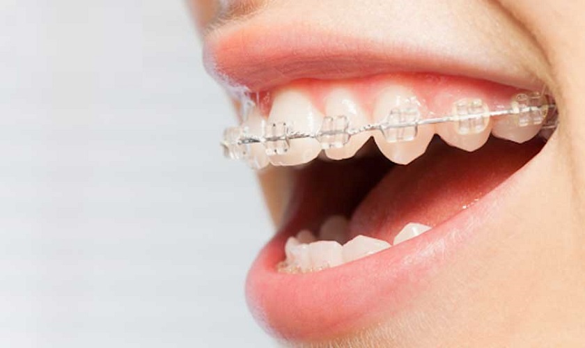 Ưu điểm của niềng răng mắc cài sứ là có màu sắc tương đồng với màu răng thật