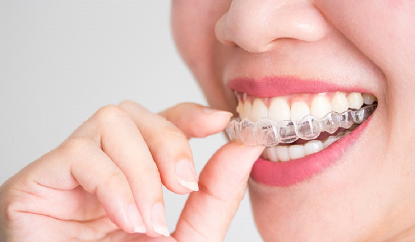 Kỹ thuật niềng răng trong suốt Invisalign