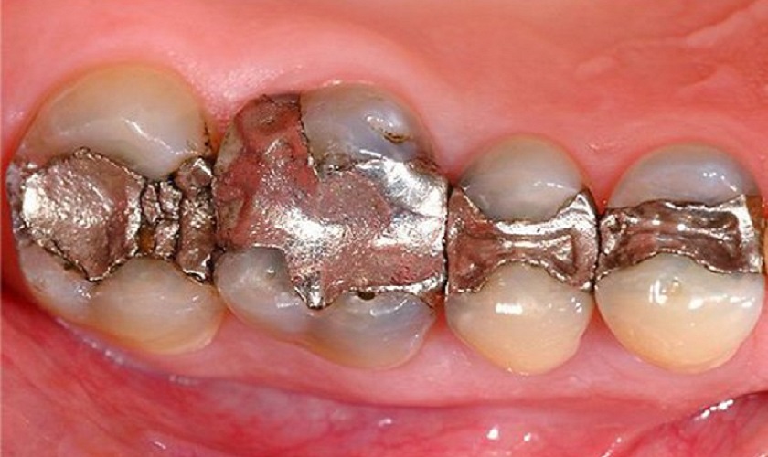 Răng sau khi trám bằng vật liệu Amalgam
