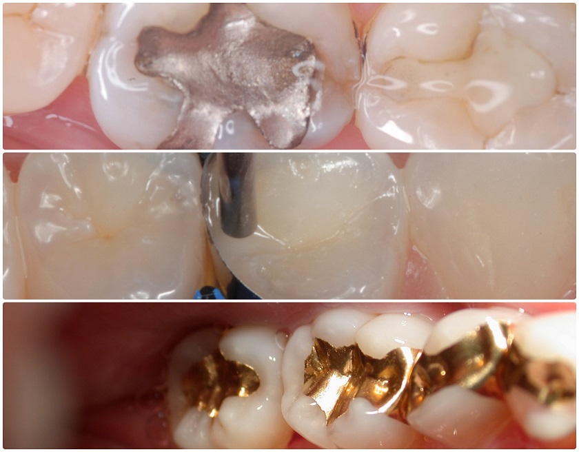 Trám răng bằng Composite so với các vật liệu khác