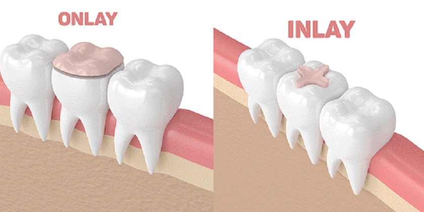 Mô phỏng phương pháp trám sứ Inlay – Onlay