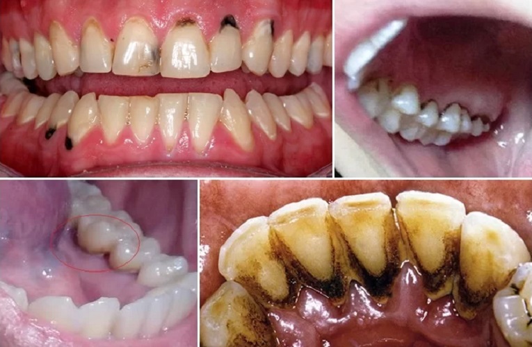 Làm thế nào để điều trị răng bị đen ở giữa?
