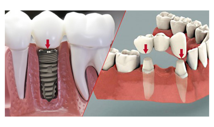 Nên trồng răng bằng cầu răng hay cấy ghép Implant khi mất răng