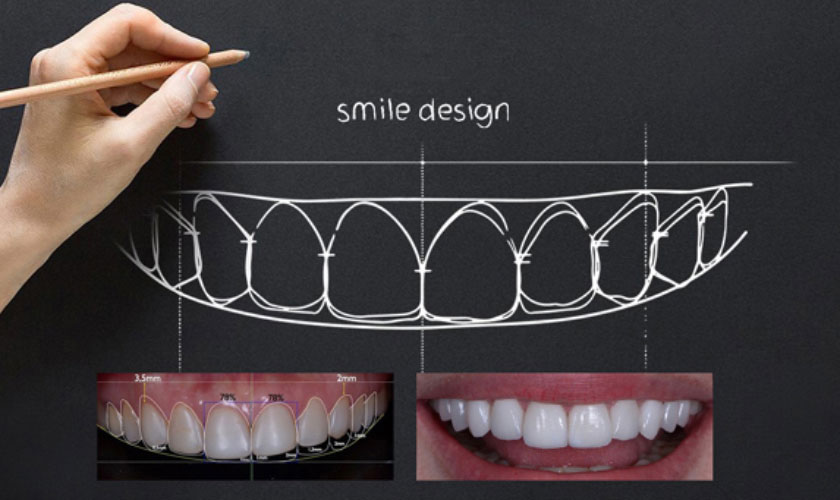 Thiết kế nụ cười sẽ giúp bạn thấy trước nụ cười sau khi điều trị Thiết kế nụ cười sẽ giúp bạn thấy trước nụ cười sau khi điều trị