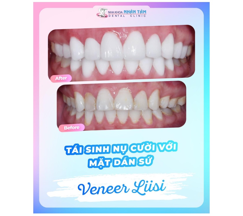 Mặt dán sứ Veneer tại Nha khoa Nhân Tâm Mặt dán sứ Veneer tại Nha khoa Nhân Tâm