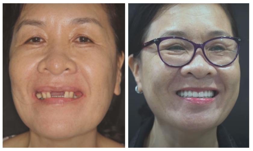 Nụ cười tươi của cô Lành sau khi điều trị