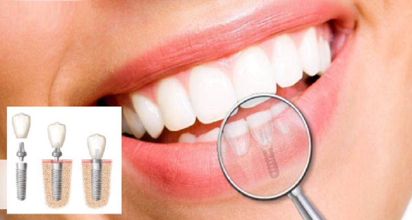 Cấy ghép Implant đảm tốt về cả mặt thẩm mỹ và chức năng ăn nhai