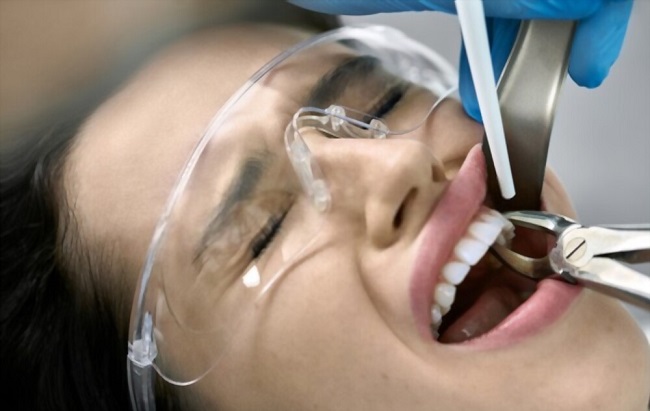 Trường hợp nghiêm trọng có thể phải nhổ răng