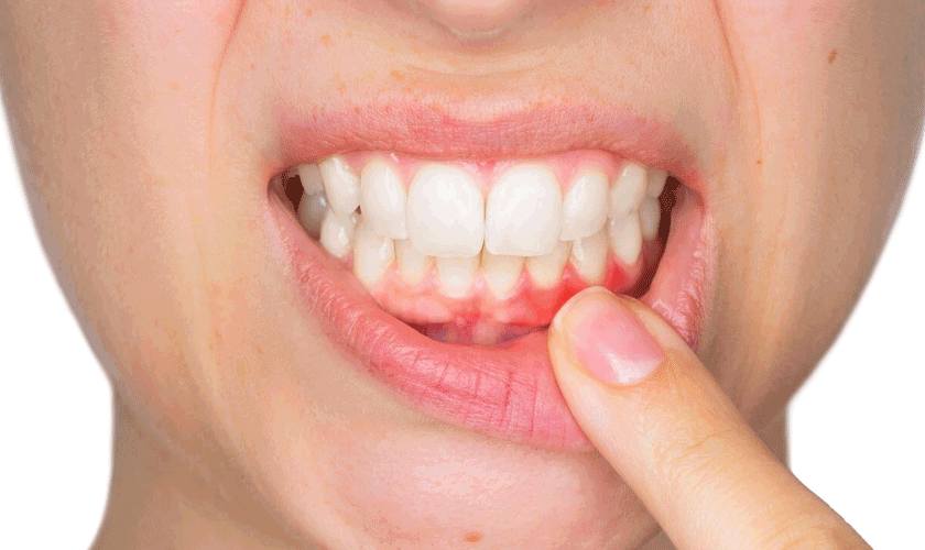 Viêm nướu kẽ răng gây sưng nướu, đỏ nướu và đau nhức cho bệnh nhân