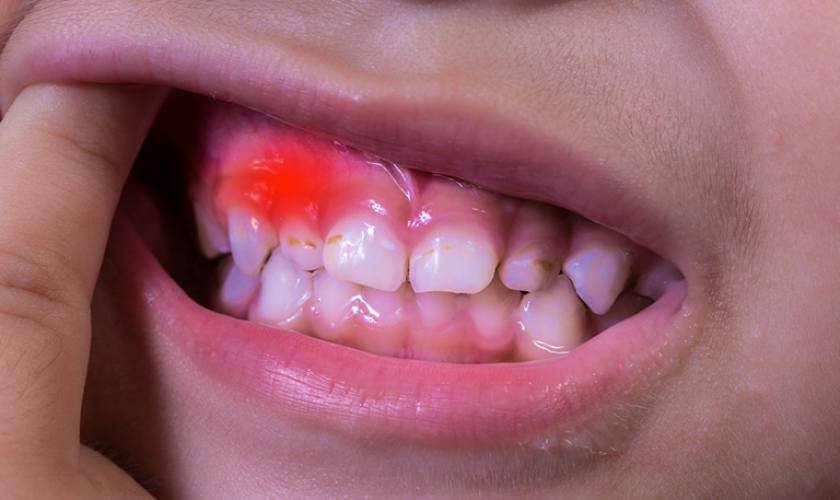 Viêm nướu kẽ răng nếu không điều trị sẽ gây viêm nhiễm diện rộng