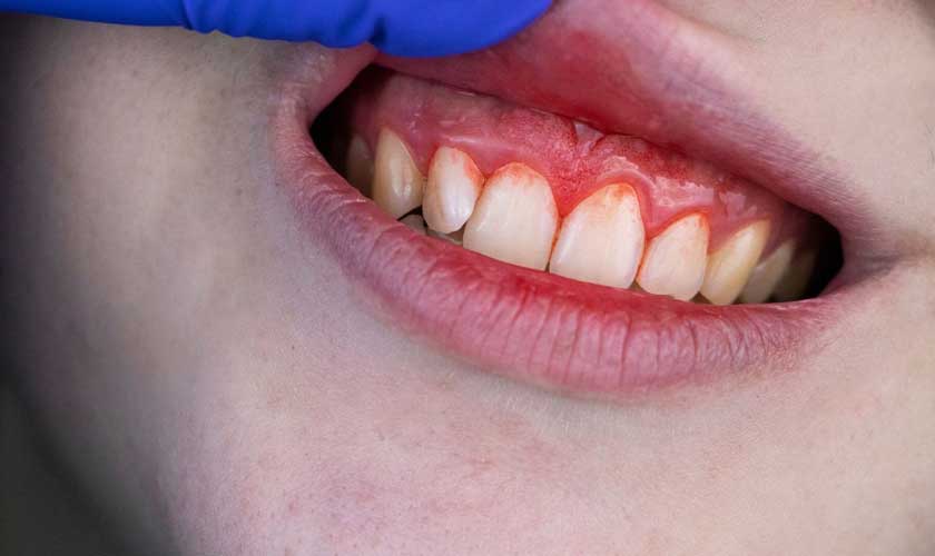 Cách điều trị viêm nướu răng bị sưng