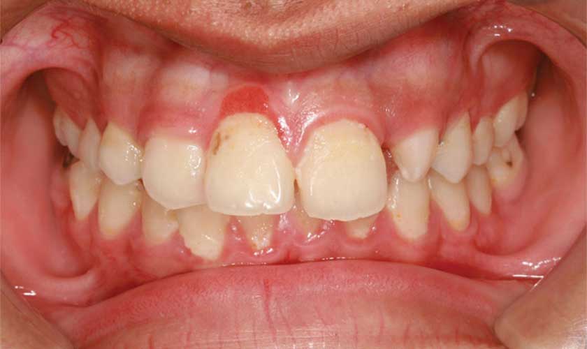 Viêm nướu răng cửa