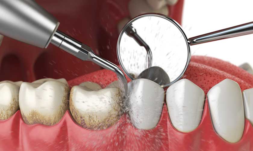 Cạo vôi răng điều trị viêm nướu