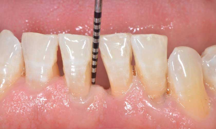 Điều trị viêm nướu răng bao nhiêu tiền?