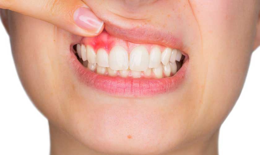 Viêm nướu răng cần được thăm khám và điều trị nhanh chóng Viêm nướu răng cần được thăm khám và điều trị nhanh chóng