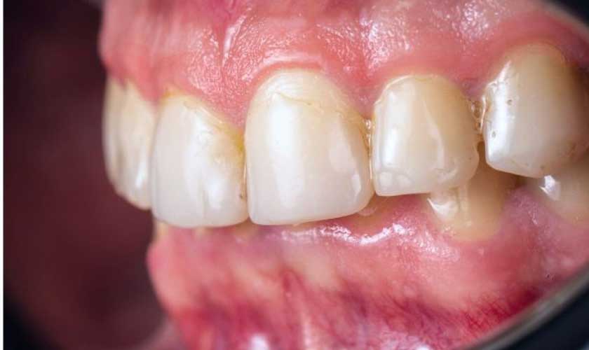 Mảng bám là môi trường để cho vi khuẩn gây bệnh trú ngụ và tấn công nướu răng Mảng bám là môi trường để cho vi khuẩn gây bệnh trú ngụ và tấn công nướu răng