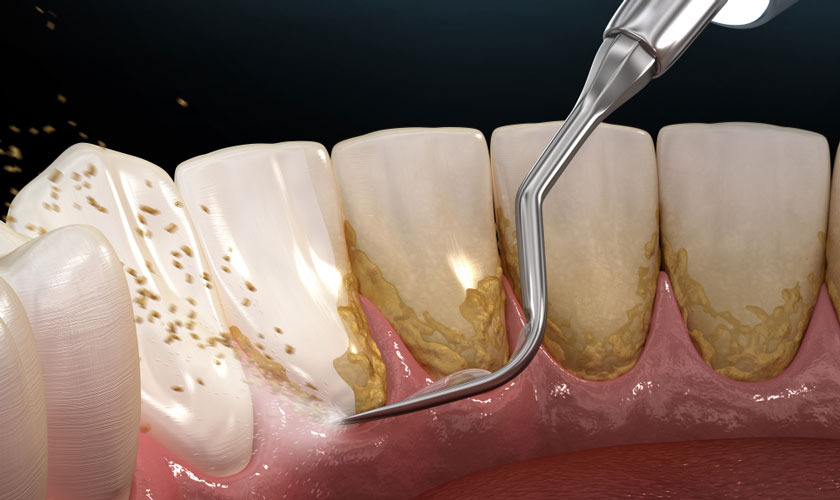 Cạo vôi răng trị viêm nướu nhanh chóng, an toàn, hiệu quả