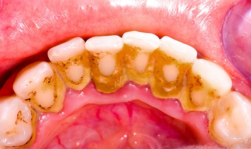 Mảng bám vôi răng tích tụ tăng nguy cơ viêm nướu răng hôi miệng