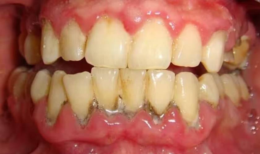 Mẹo chữa viêm nướu răng hiệu quả tại nhà