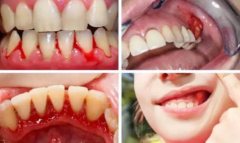 Nhận biết triệu chứng viêm nướu qua hình ảnh viêm nướu răng