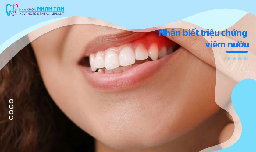 Nhận biết triệu chứng viêm nướu qua hình ảnh viêm nướu răng 