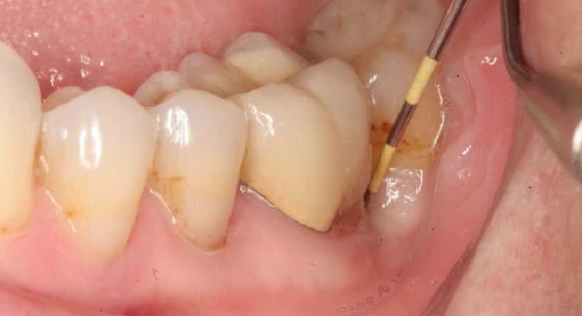 Viêm nướu răng hàm