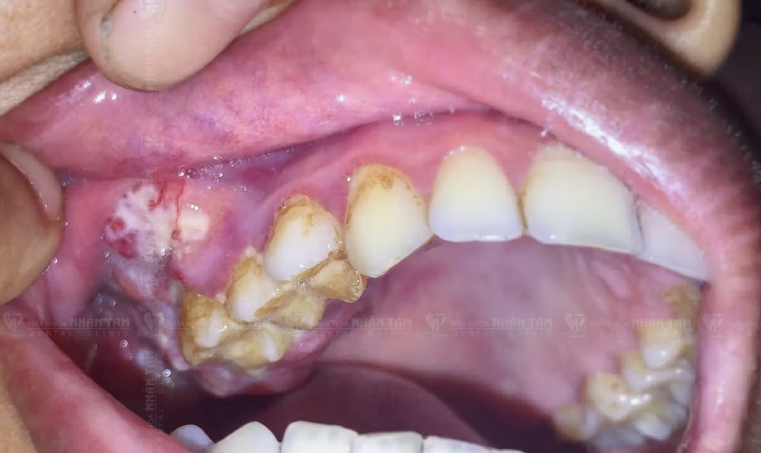 Xuất hiện khối u ở nướu