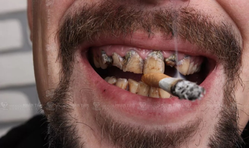 Hút thuốc lá tăng tỷ lệ ung thư nướu