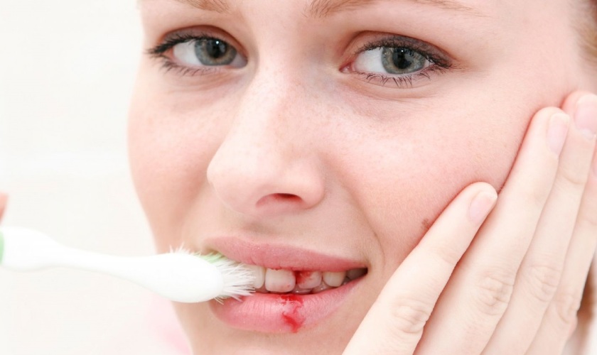 Bệnh viêm nướu có thể gây chảy máu khi đánh răng