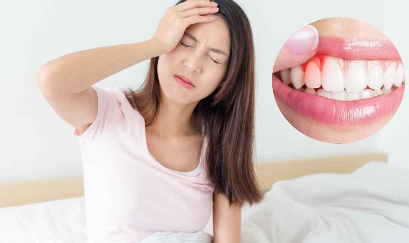 Viêm nướu răng có bị sốt không?