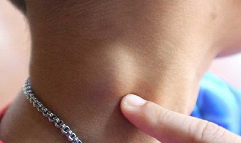 Viêm nướu răng có nổi hạch không?