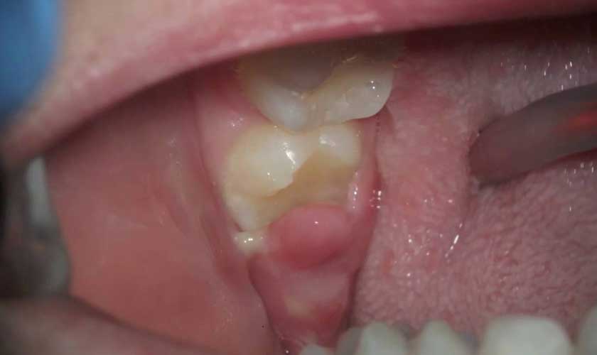 Viêm nướu răng do răng khôn mọc kẹt