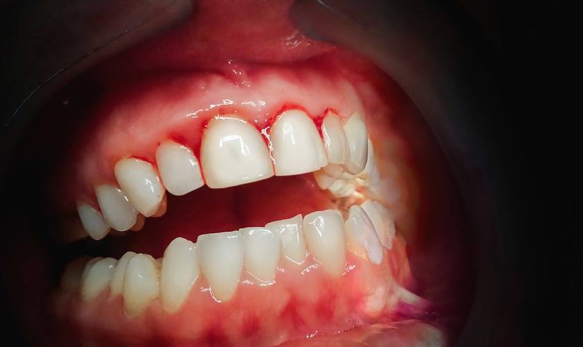 Viêm nướu răng có tự hết không?