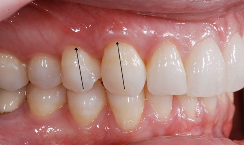 Nhận biết tình trạng nướu bị sưng đỏ