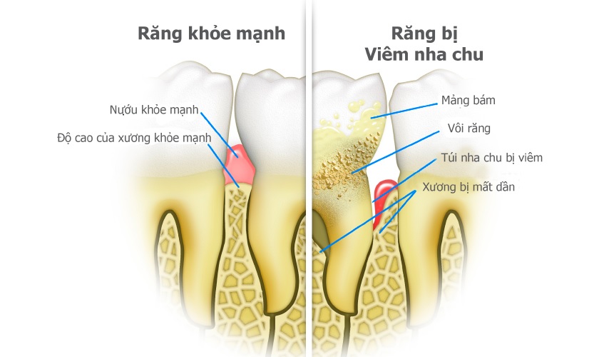 Bệnh nha chu và những nhận biết cần lưu ý