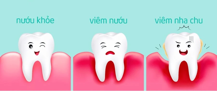Dấu hiệu nhận biết bệnh nha chu là gì?