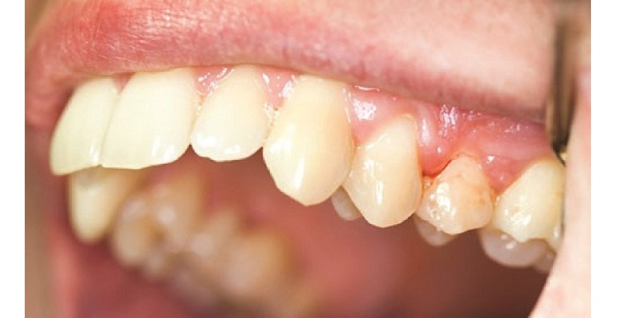 Điều trị bệnh nha chu để bảo tồn răng