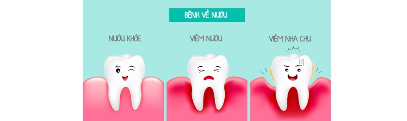 Cách phòng chống bệnh về nướu