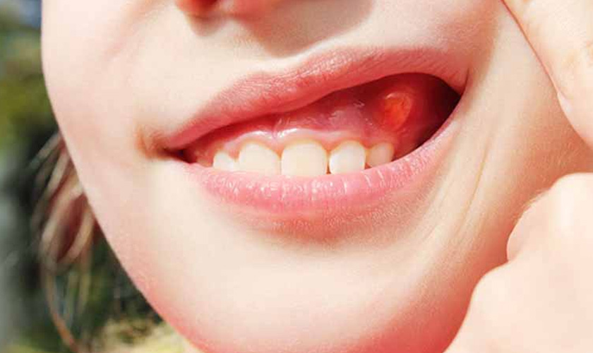 Nguyên nhân và cách điều trị viêm chân răng có mủ