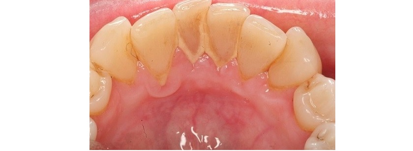 Răng bị nha chu viêm