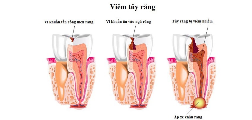 Răng bị bệnh về tuỷ