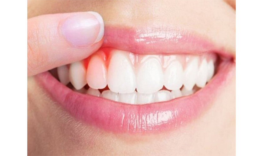 Nguyên nhân chảy máu chân răng và cách điều trị hiệu quả?