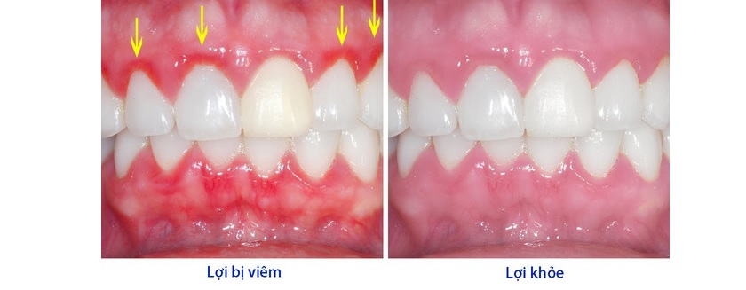 Viêm lợi cũng là một trong những nguyên nhân dẫn đến tình trạng chảy máu chân răng