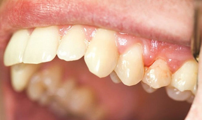 Khi mang thai, sự gia tăng hormone trong cơ thể khiến bạn dễ bị viêm nướu