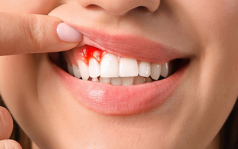 Nguyên nhân chảy máu chân răng và cách khắc phục