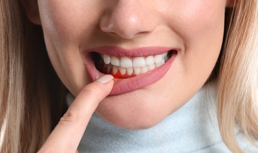 Liều lượng thuốc bôi Metrogyl Denta thay đổi như thế nào theo từng bệnh nhân?
