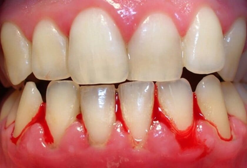 Hình ảnh viêm chân răng giúp nhận biết dấu hiệu và cách điều trị