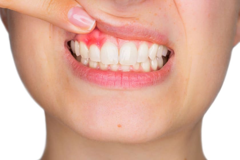 Hình ảnh viêm chân răng giúp nhận dấu hiệu và cách điều trị