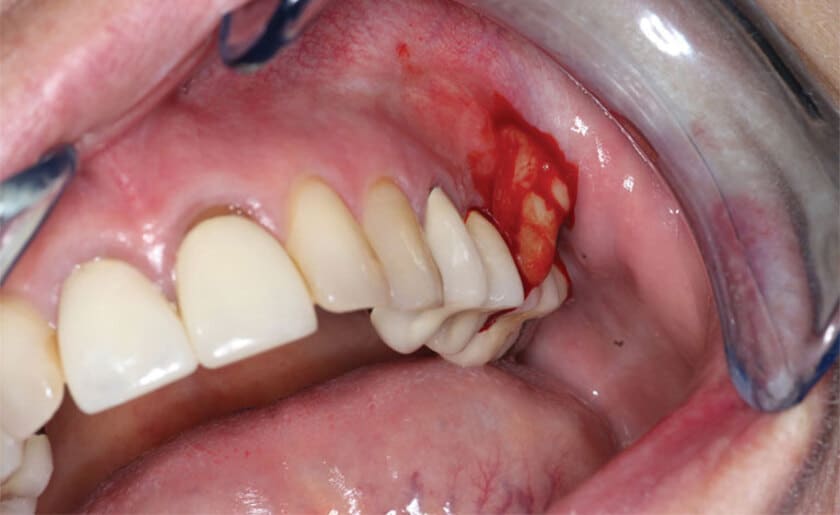Hình ảnh viêm chân răng giúp nhận biết dấu hiệu và cách điều trị
