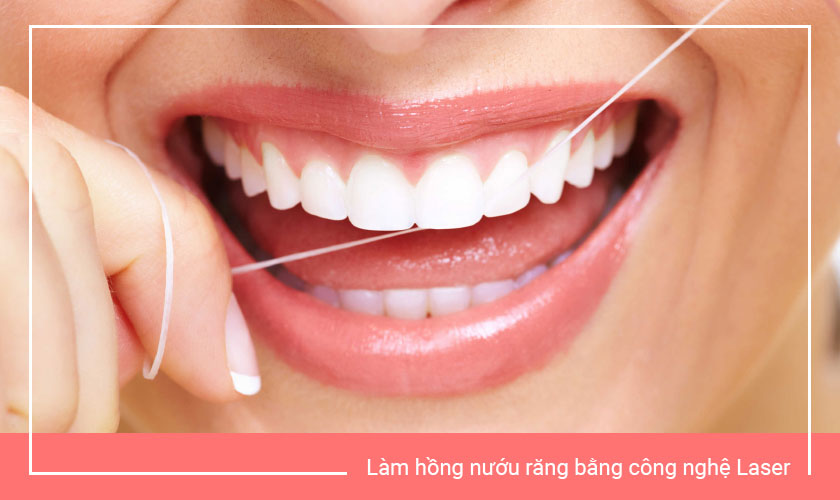 Làm hồng nướu răng với công nghệ Laser